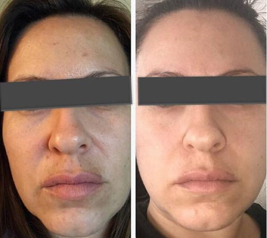 Microcurrent Full Face - One Month Treatment Kit