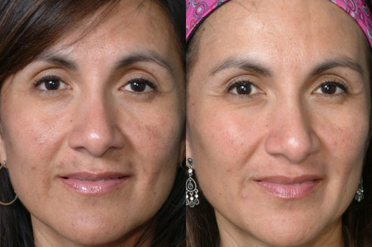 Microcurrent Full Face - One Month Treatment Kit